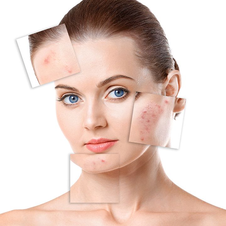 Acne scars treatment