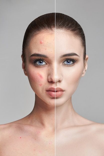 Acne treatment
