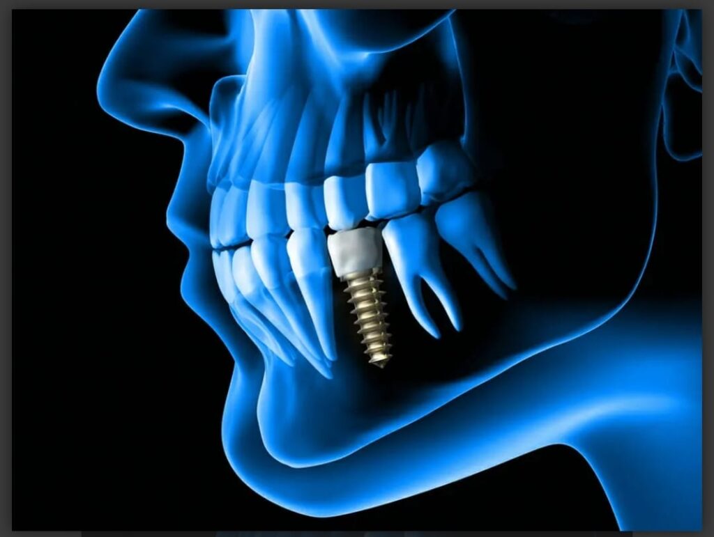 Dental Implants