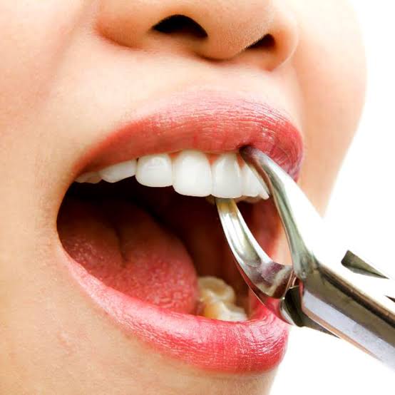 Extractions