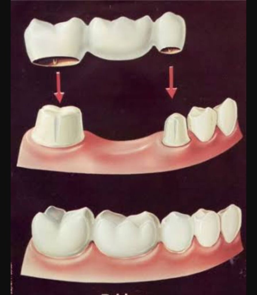 Fixed teeth