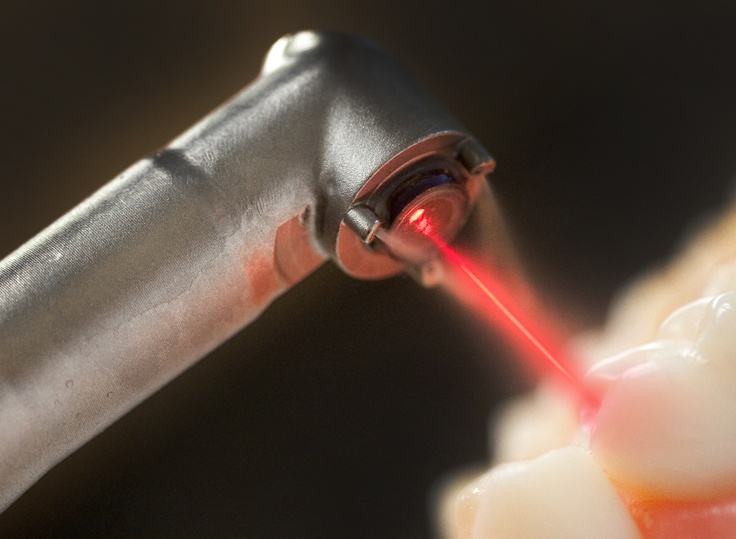 Laser Fillings