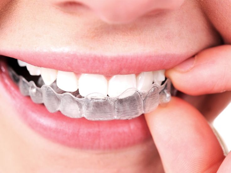 Ortho treatment with braces or Clear aligners