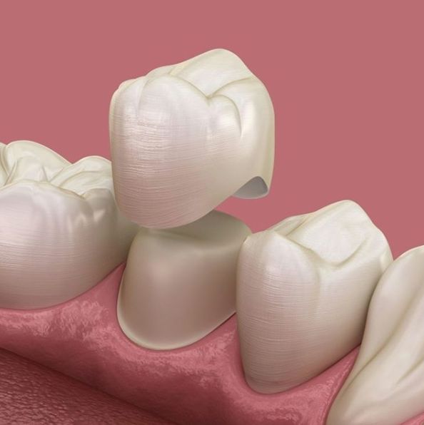 PFM and Zirconia Caps (1)