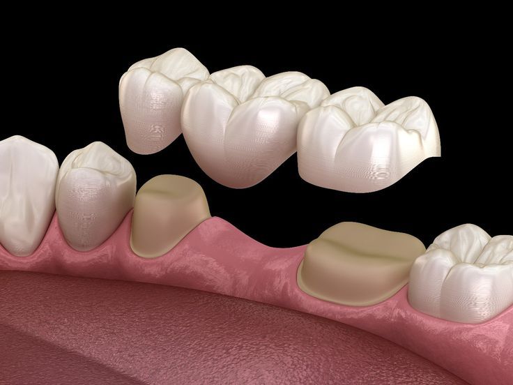 Removable dentures