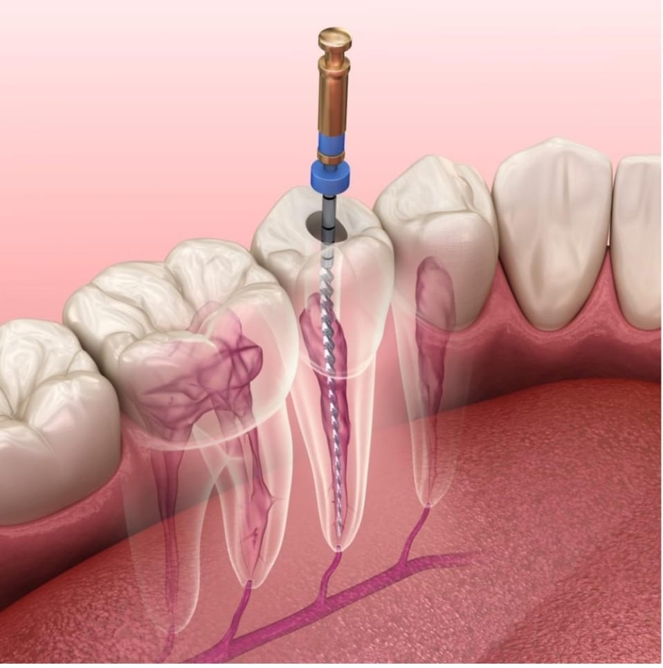 Root Canal Treatment (RCT)
