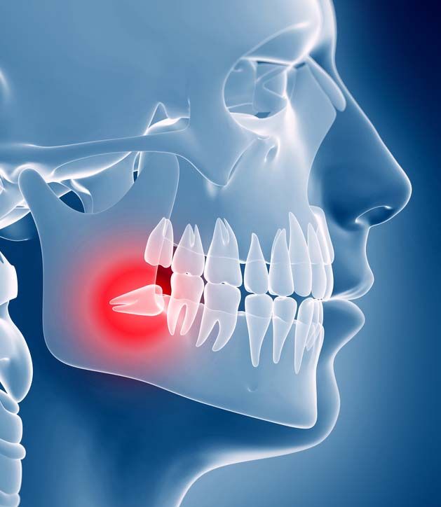 Wisdom Tooth Extraction