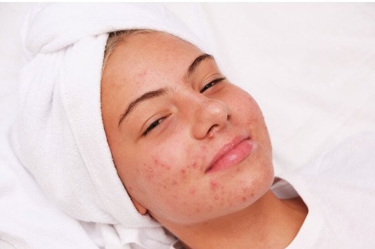 acne-treatment-2